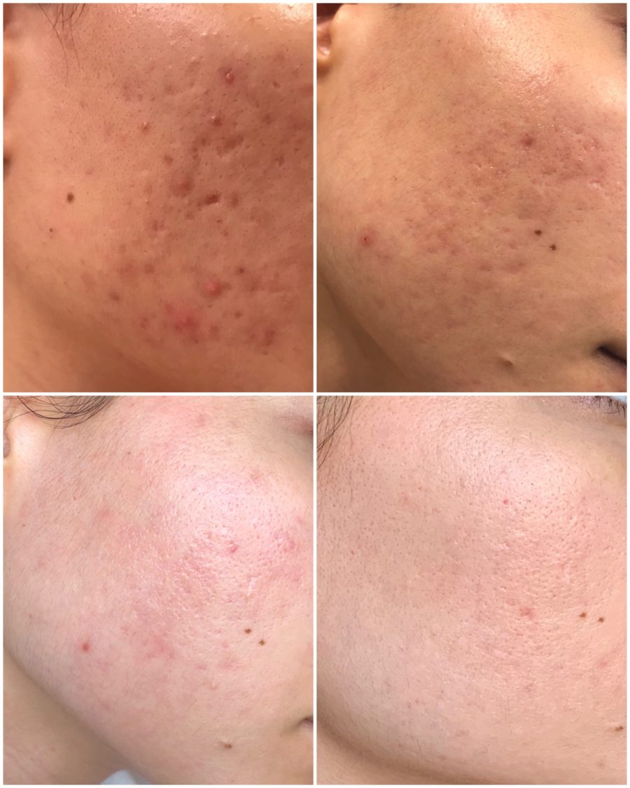 acne improvement photos