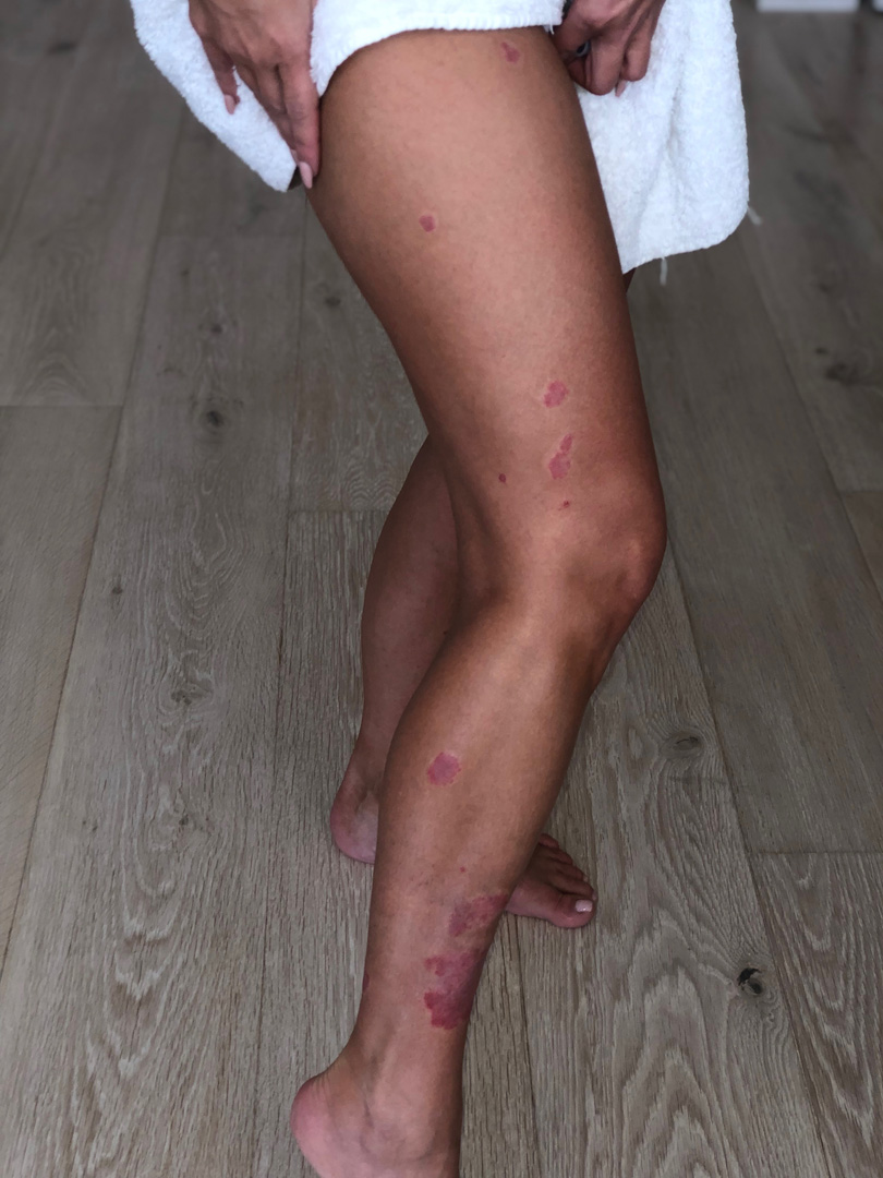 Kim Kardashian West Psoriasis on full leg