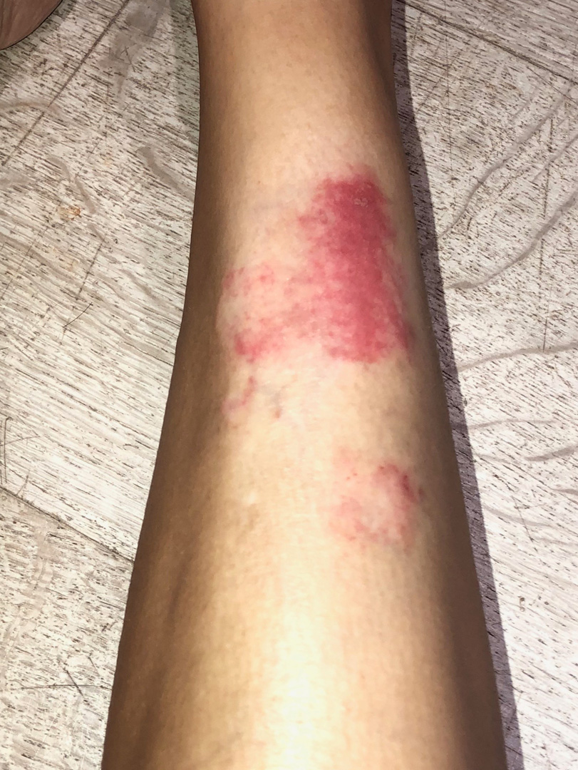 Kim Kardashian West photo of Psoriasis on her leg