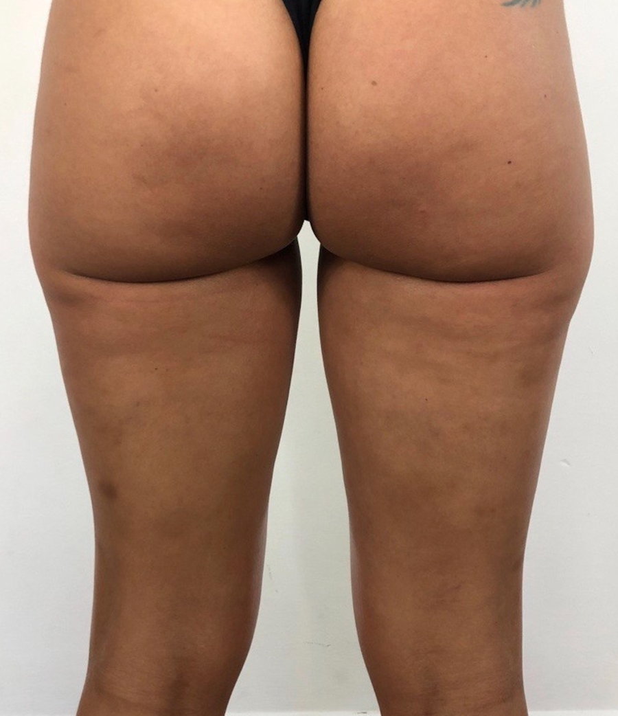 Cellulite on legs before