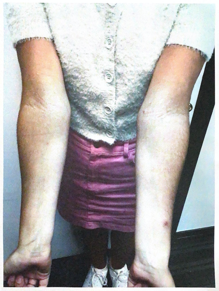 severe eczema on arms after treatment