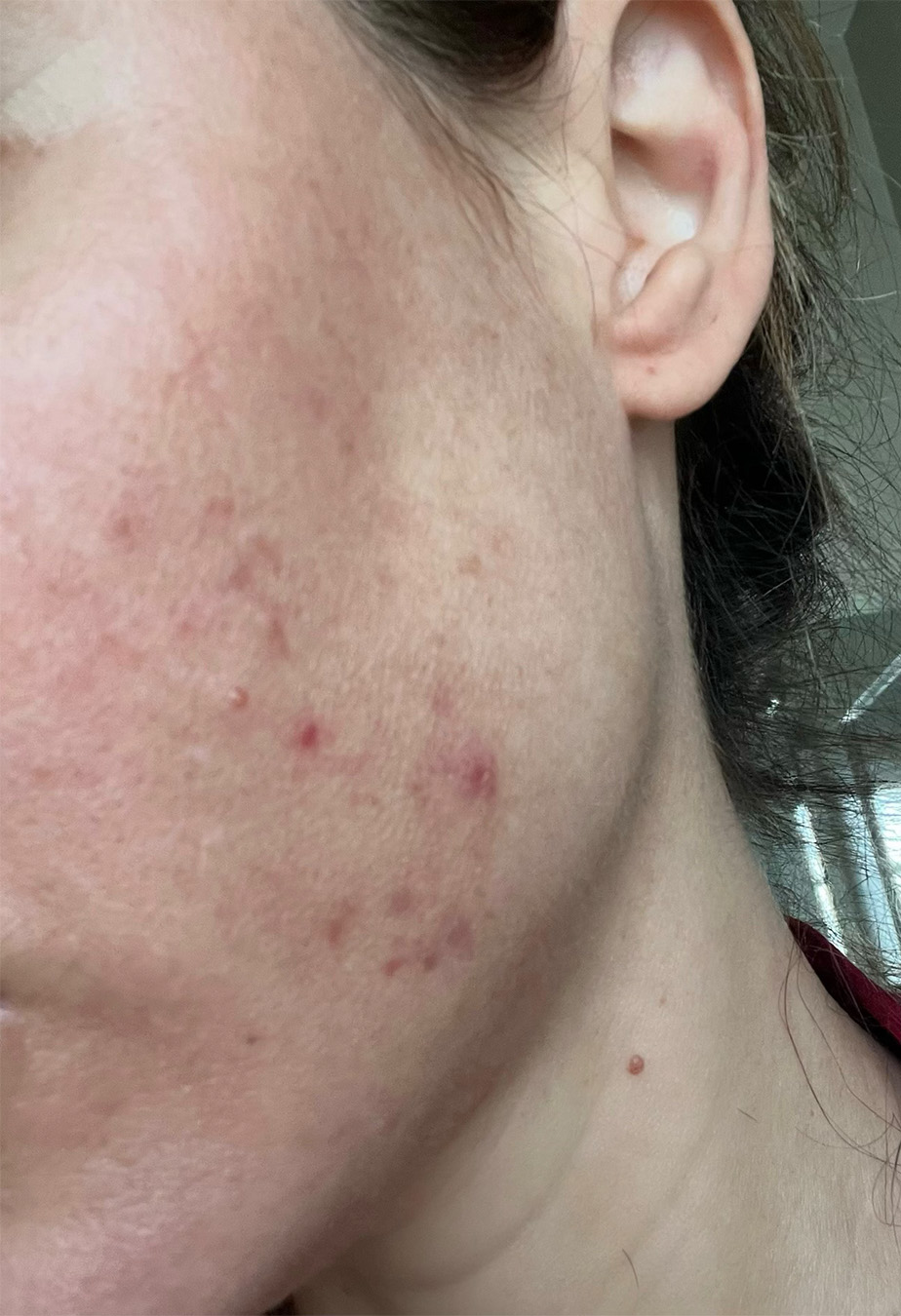 Here&#8217;s What Acne is Like in My 40s